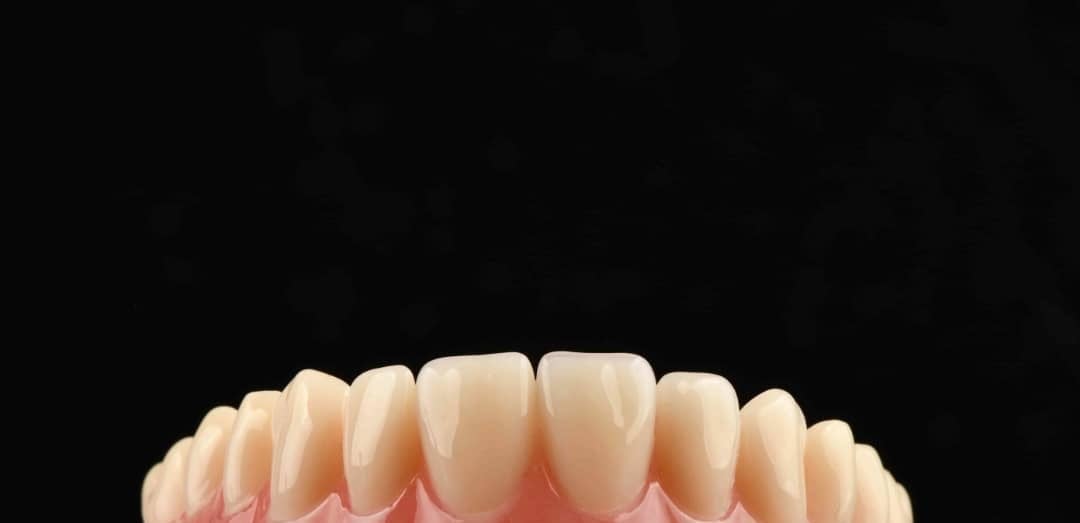 Full upper arch of anterior crowns showing natural shade and finish