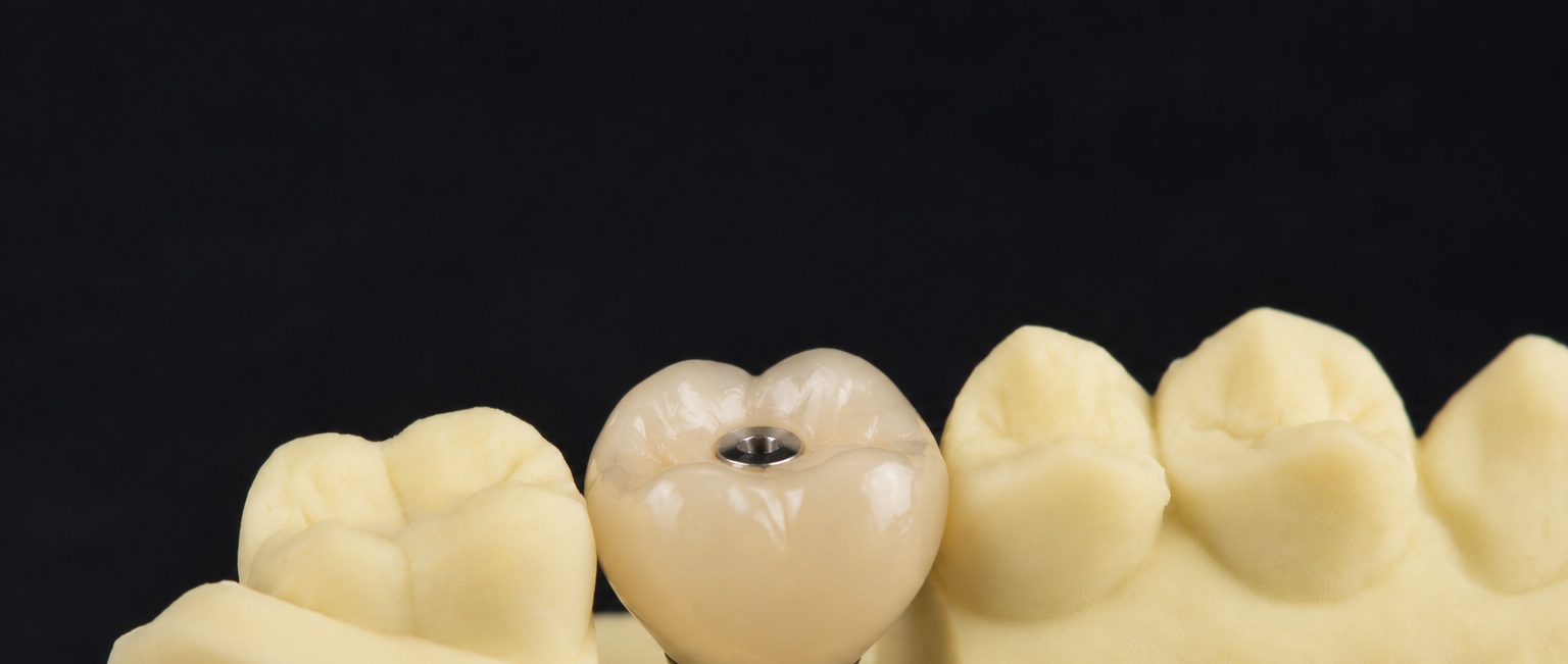 Screw-retained implant crown with visible access channel